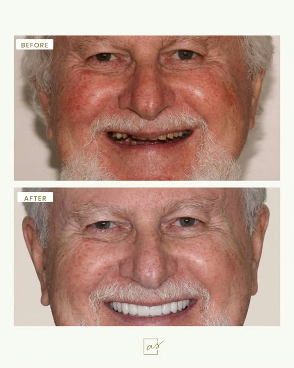 Dental Implants Before & After Gallery - Patient 1 - Image 1