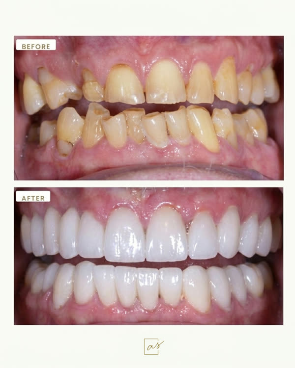 Dental Implants Before & After Gallery - Patient 1 - Image 2