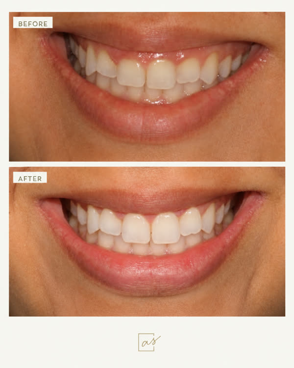 Smile Makeover Before & After Gallery - Patient 2 - Image 1