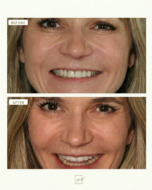 Smile Makeover Before & After Gallery - Patient 3 - Image 1