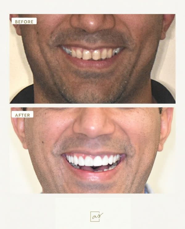 Smile Makeover Before & After Gallery - Patient 5 - Image 1