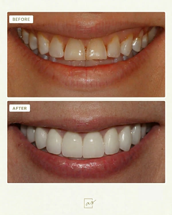 Smile Makeover Before & After Gallery - Patient 7 - Image 1