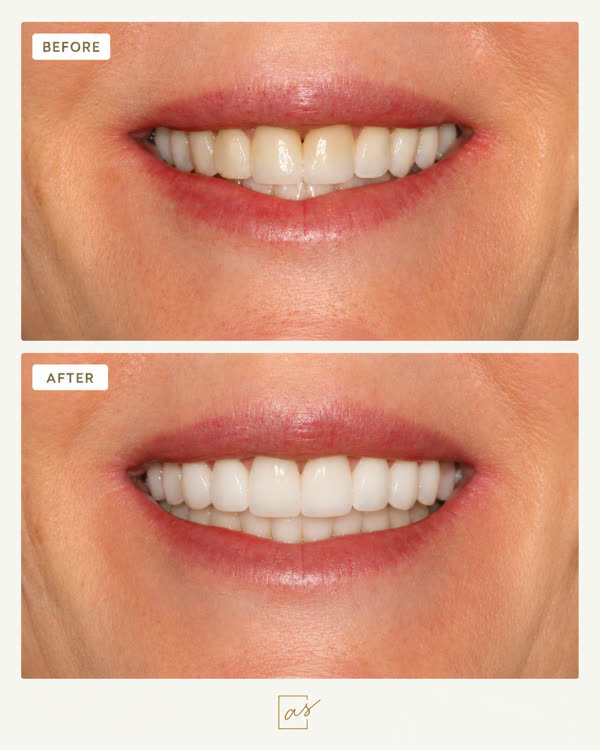 Smile Makeover Before & After Gallery - Patient 9 - Image 1