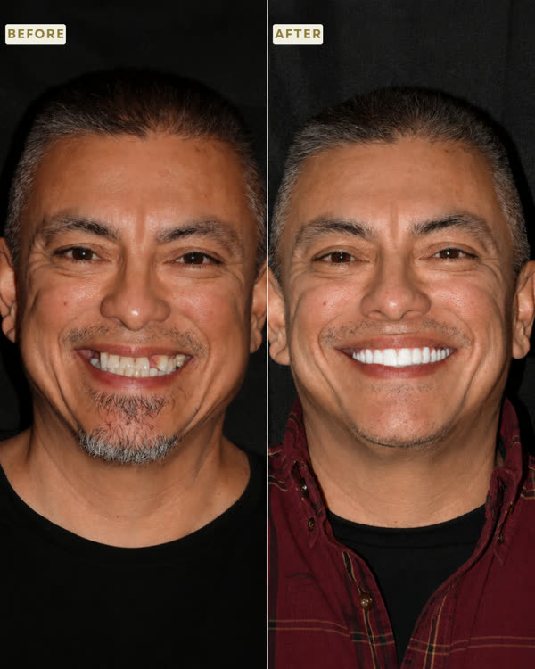 Dental Implants Before & After Gallery - Patient 2 - Image 1