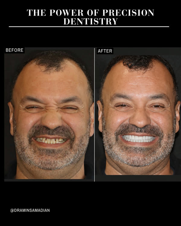 Dental Implants Before & After Gallery - Patient 3 - Image 1