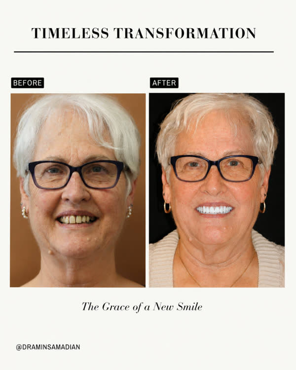Dental Implants Before & After Gallery - Patient 4 - Image 1