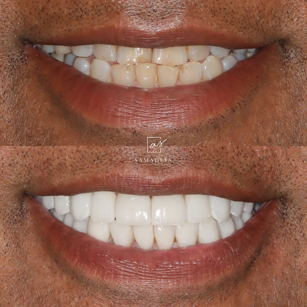 Smile Makeover Before & After Gallery - Patient 12 - Image 1