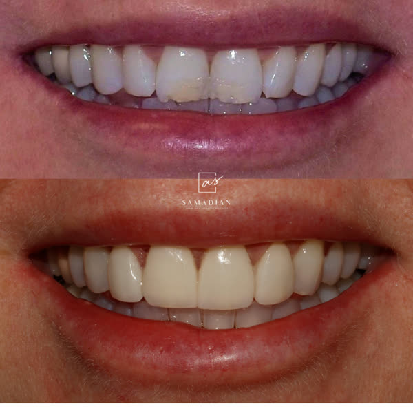 Smile Makeover Before & After Gallery - Patient 13 - Image 1