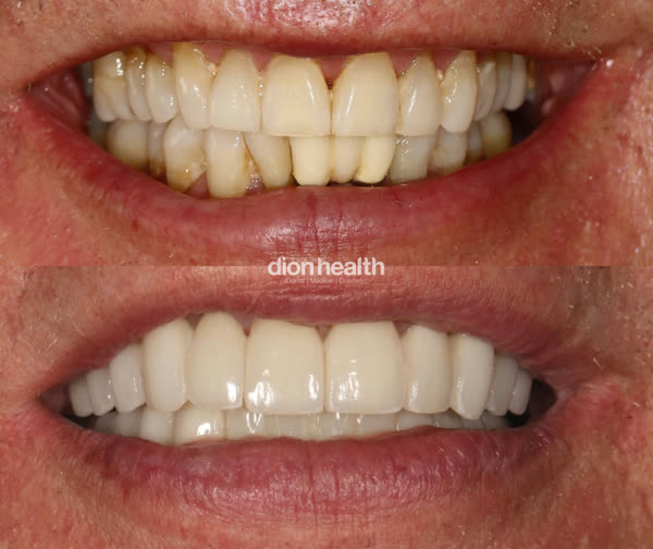 Smile Makeover Before & After Gallery - Patient 15 - Image 1