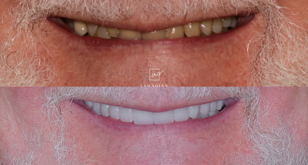 Dental Implants Before & After Gallery - Patient 6 - Image 1