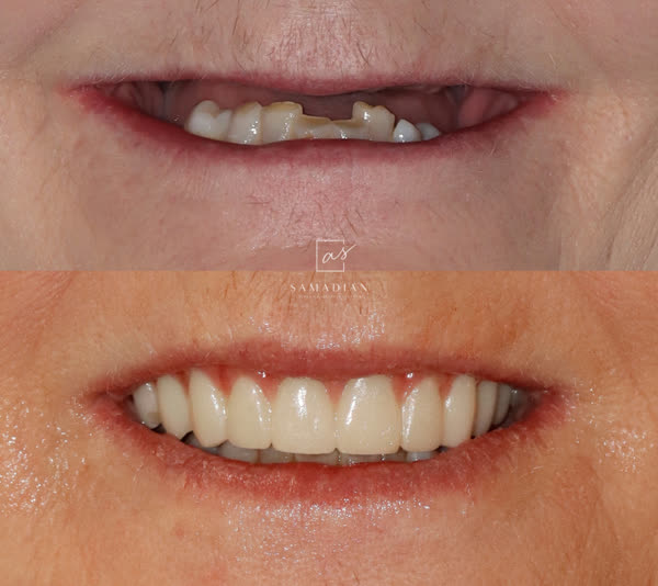Dental Implants Before & After Gallery - Patient 5 - Image 1