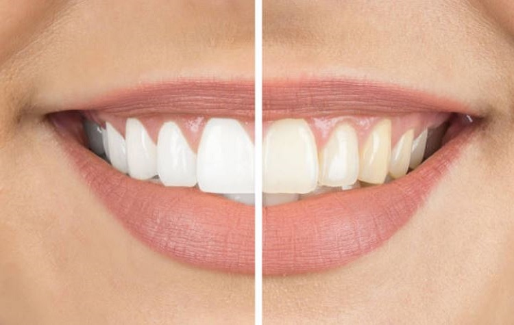 Teeth Whitening San Francisco