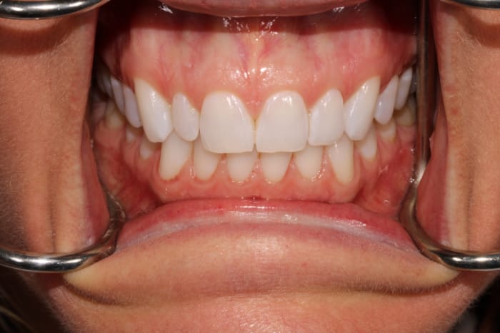 No-Prep Veneers