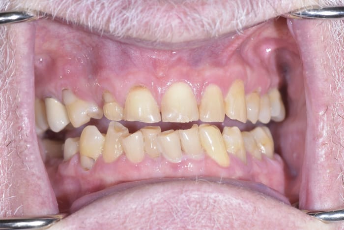 Before and after a Smile Makeover in San Francisco with Dr. Samadian