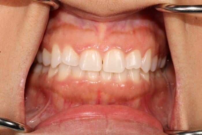 Veneers Before & After Gallery - Patient 39774549 - Image 1