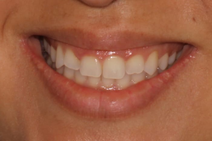 Veneers Before & After Gallery - Patient 39774549 - Image 3