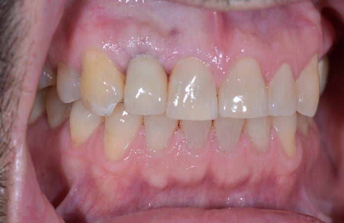 Dental Implants results in San Francisco with Dr. Samadian