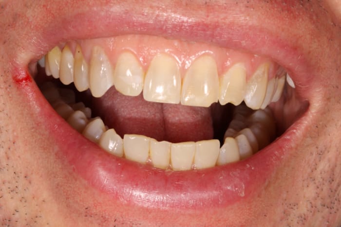 Before and after Dental Bondings in San Francisco with Dr. Samadian