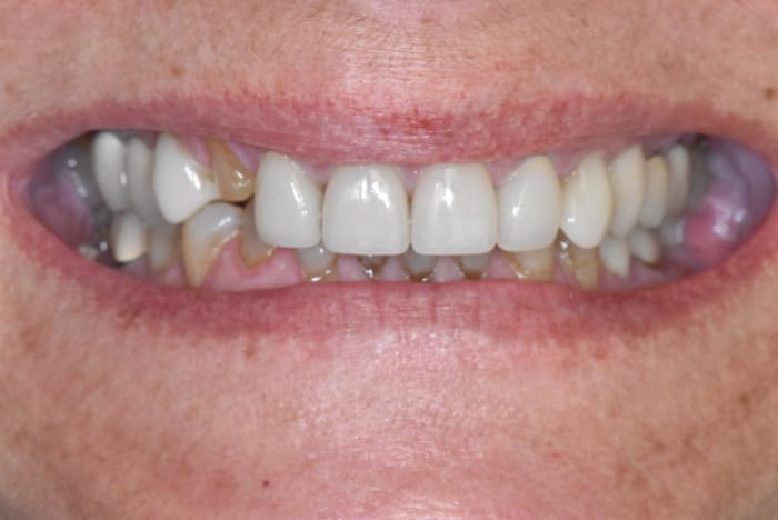 Veneers Before & After Gallery - Patient 39578479 - Image 1