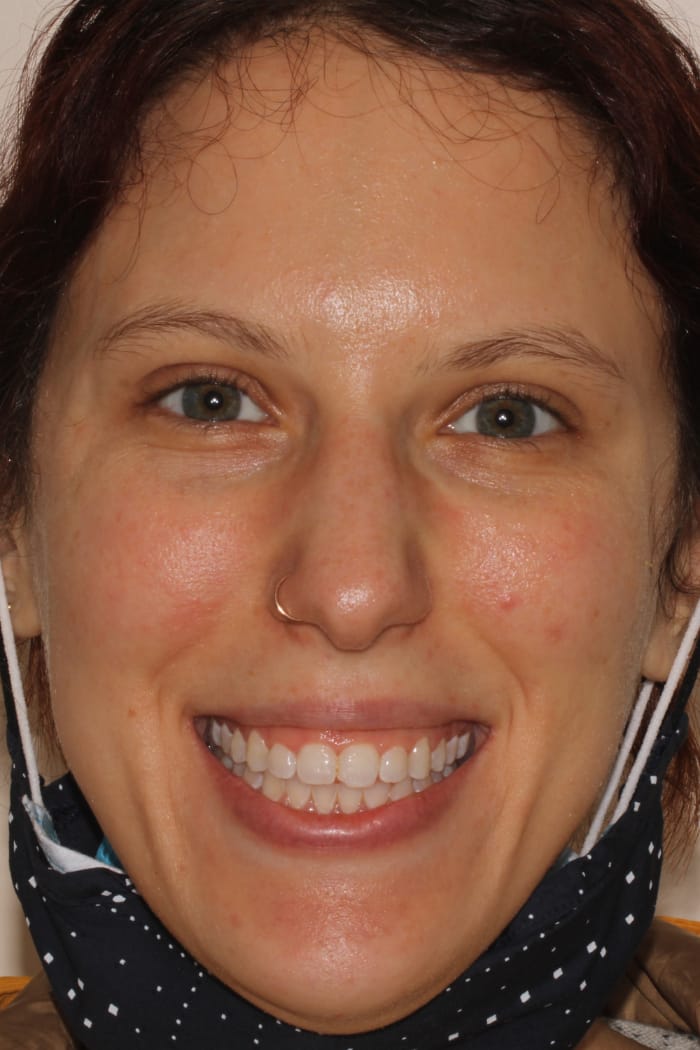 Laser Gum Contouring Before & After Gallery - Patient 39578489 - Image 1