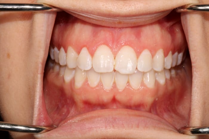 Laser Gum Contouring Before & After Gallery - Patient 39578489 - Image 4