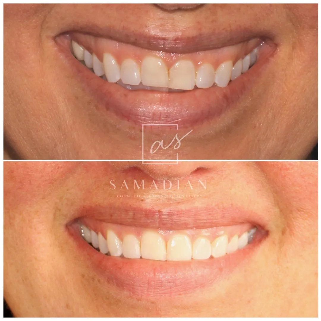 Laser Gum Contouring Before & After Gallery - Patient 121543652 - Image 1