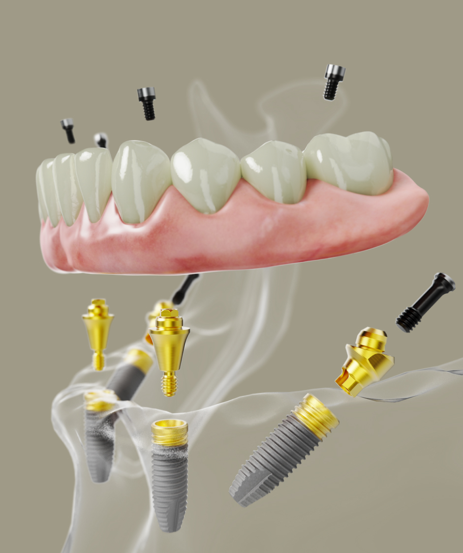 dental implant
